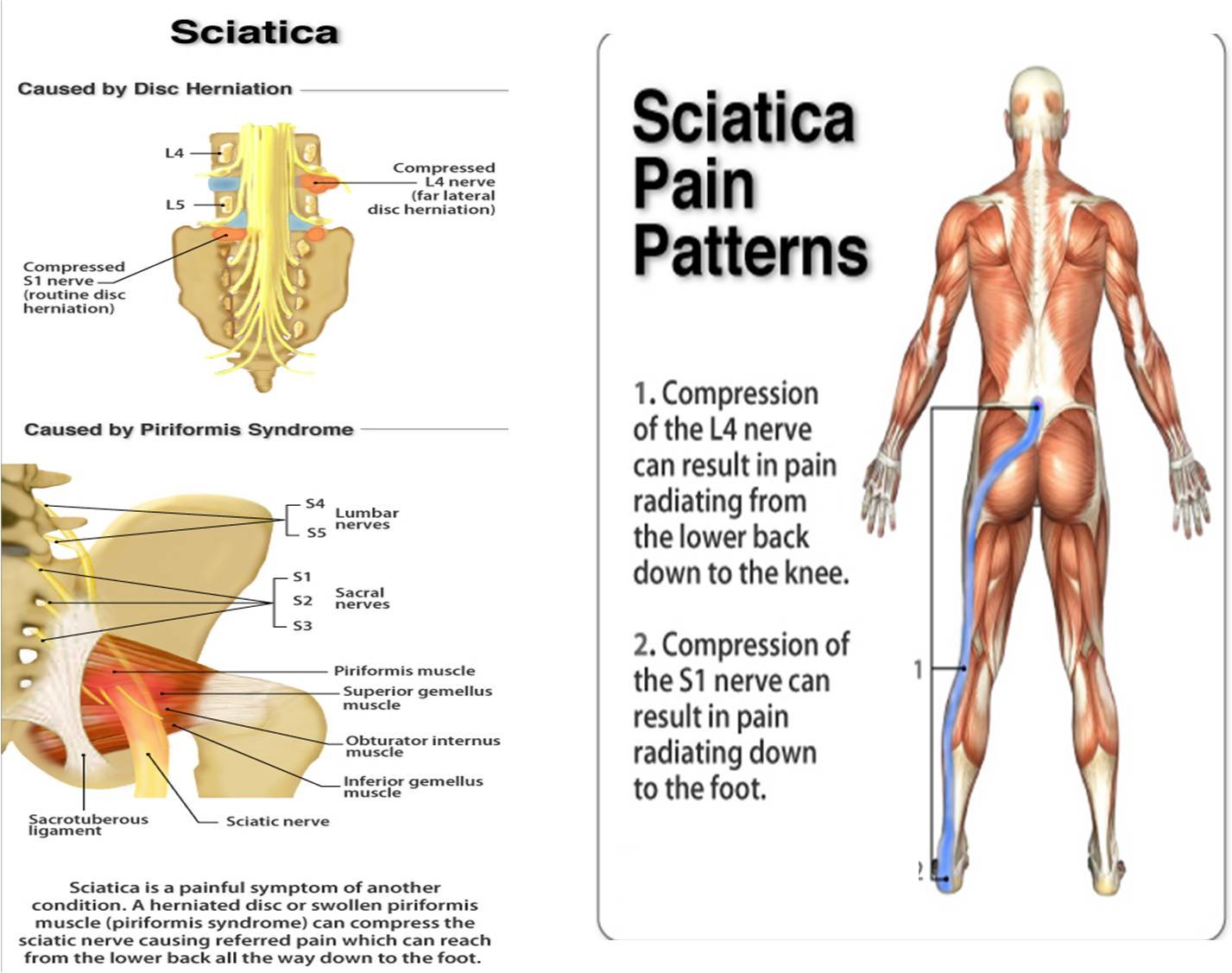 sciatica-pain-pic-pranic-healing.jpg